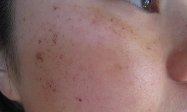 skin-spots