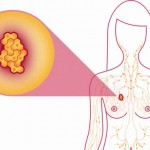 metastatic-breast-cancer