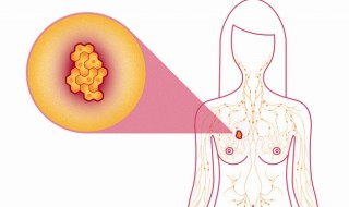 metastatic-breast-cancer