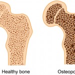 osteoporosis-causes-and-prevention