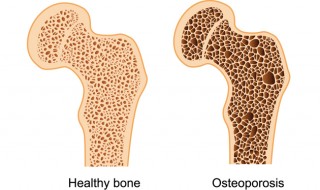 osteoporosis-causes-and-prevention