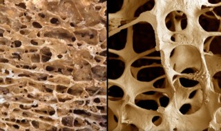 osteoporosis-and-intake-of-carbohydrates