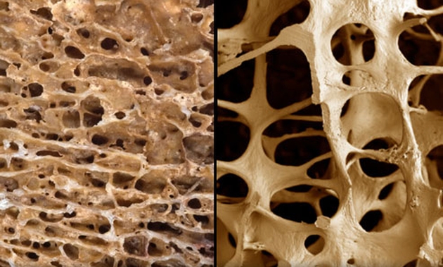osteoporosis-and-intake-of-carbohydrates