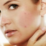adult-acne-remedies