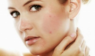 adult-acne-remedies