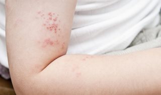 shingles-symptoms-treatment-causes