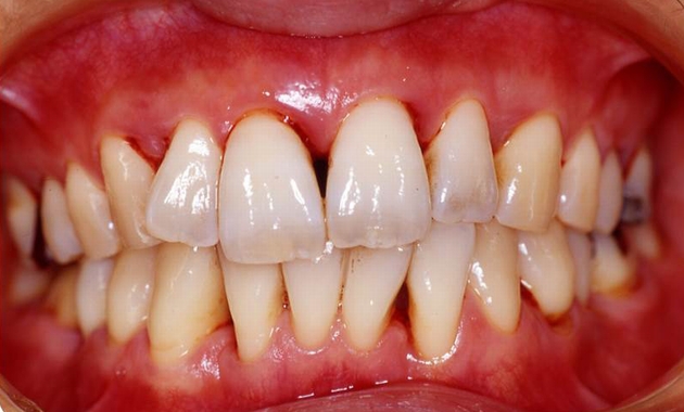 periodontal-disease-causes-and-prevention