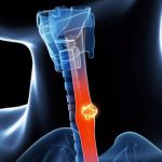 esophageal-cancer-symptoms-causes-prevention