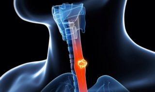 esophageal-cancer-symptoms-causes-prevention